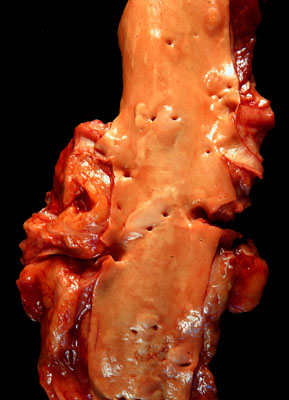 Aorta of a middle-aged man (prostate unavailable)